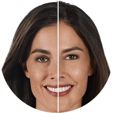 Before and after Botox treatment